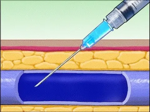 الحقن الوريدي